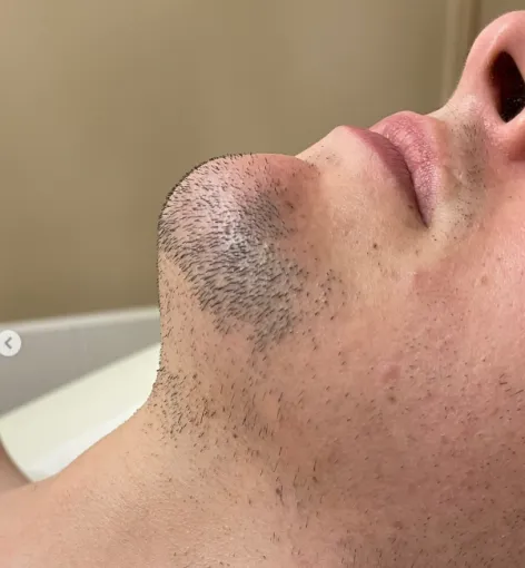 EPILATION LASER DE LA BARDE À MAISONS-ALFORT, Alfortville, GLOW STUDIO